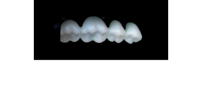 Cod.S4LOWER LEFT : 15x  posterior solid (not hollow) wax bridges, X-SMALL, (37-34) , with precarved occlusion to Cod.S4UPPER LEFT,and compatible to Cod.E4LOWER LEFT (hollow), (37-34)
